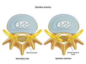 spinálna stenóza, diagnostika a liečba pomocou fyzioterapie. Bolestcrbta.sk